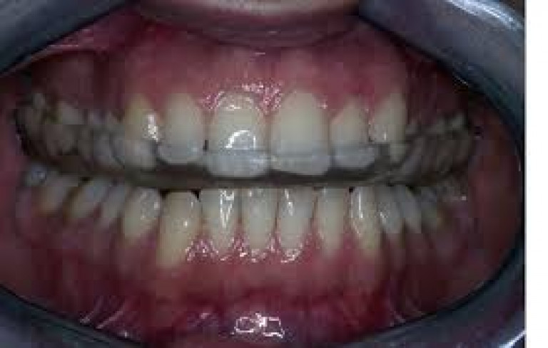 Dental Splint Brisbane | Jaw Pain, TMJ & Nightguards